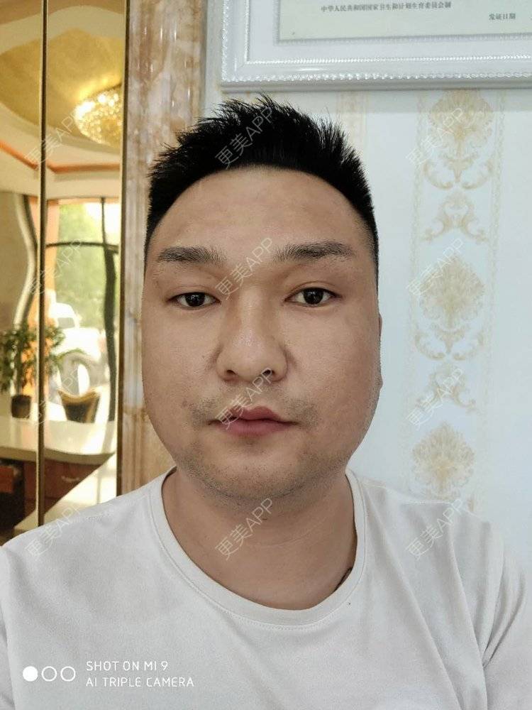 更美 - 更美用户jyH1y3DCRQ的玻尿酸溶解酶经验 | 玻尿酸溶解酶 | 玻尿酸面部细纹