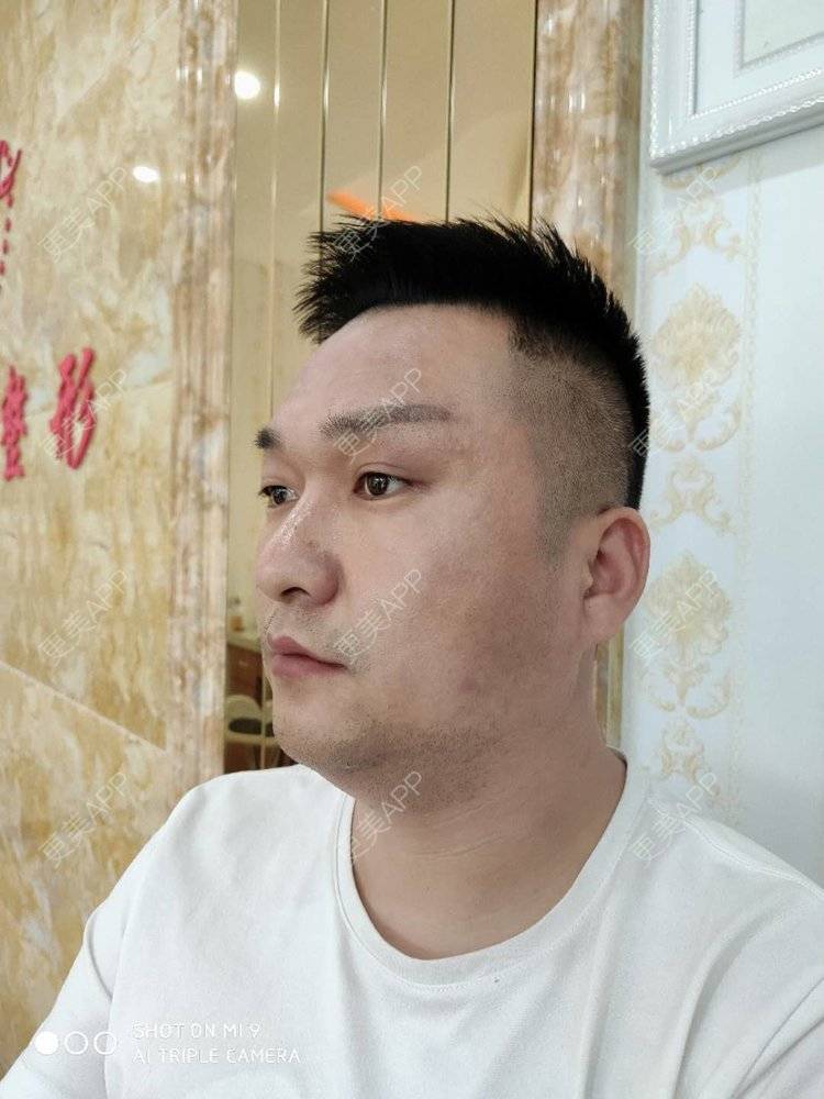 更美 - 更美用户jyH1y3DCRQ的玻尿酸溶解酶经验 | 玻尿酸溶解酶 | 玻尿酸面部细纹