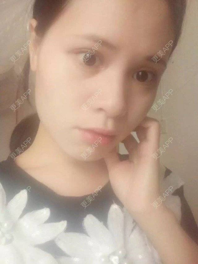 更美 - 卫星co66878的像素激光经验 | 像素激光 | 化学剥脱淡斑 | 注射美白 | 深圳