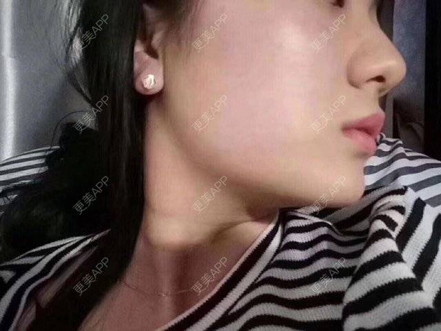 更美 - 卫星co66878的像素激光经验 | 像素激光 | 化学剥脱淡斑 | 注射美白 | 深圳