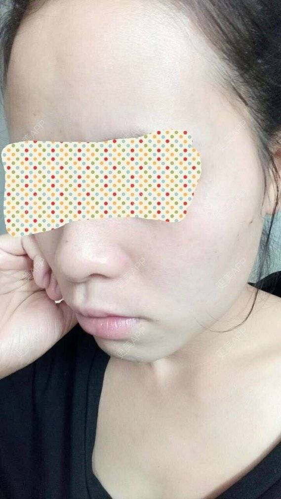 更美 - 卫星co66878的像素激光经验 | 像素激光 | 化学剥脱淡斑 | 注射美白 | 深圳