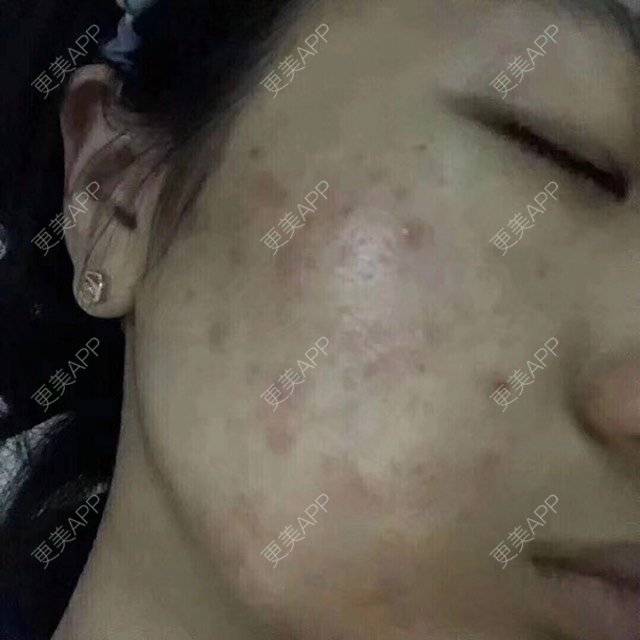 更美 - 卫星co66878的像素激光经验 | 像素激光 | 化学剥脱淡斑 | 注射美白 | 深圳