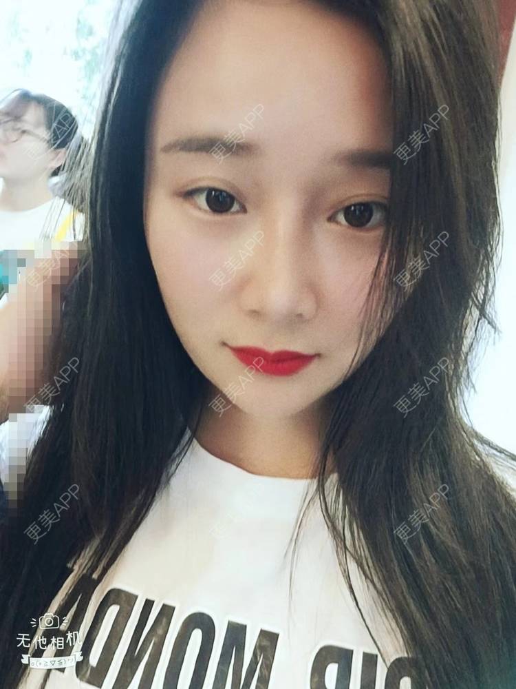 更美 - 更美用户J1mgNZN5cT的鼻部多项经验 | 鼻部多项 | 成都