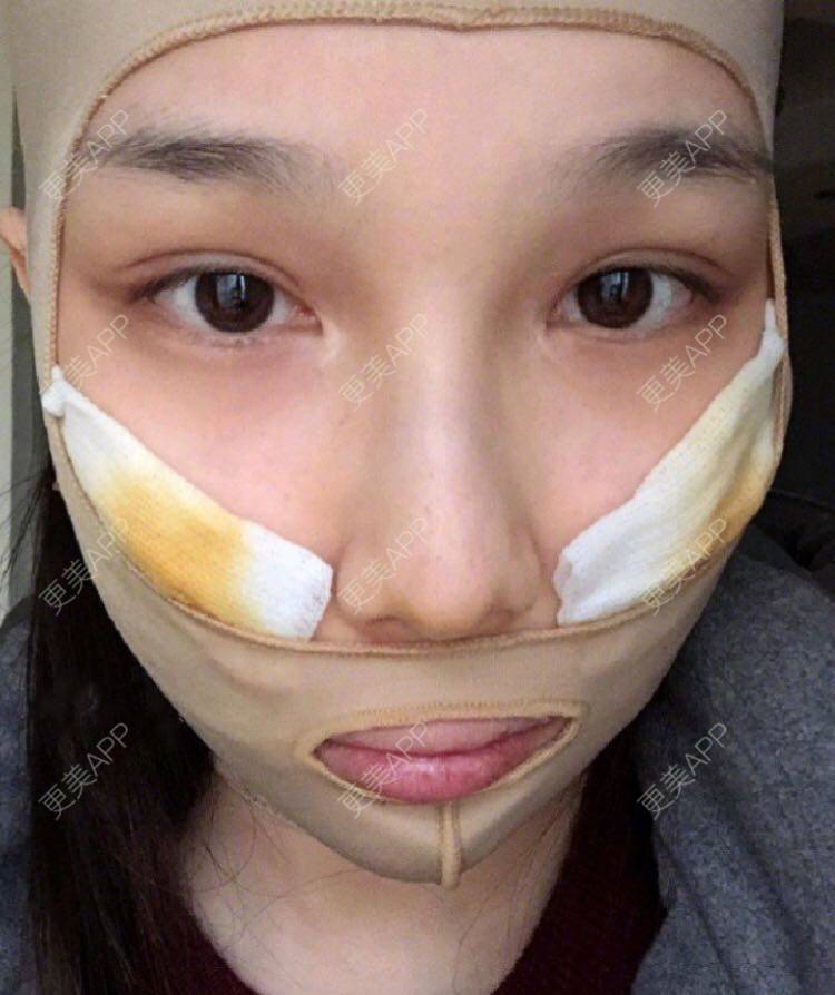 更美 - 愿out¨的颧骨内推经验 | 北京 | 颧骨内推