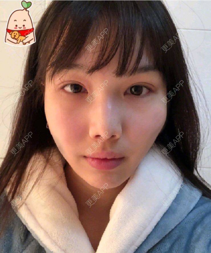 更美 - 愿out¨的颧骨内推经验 | 北京 | 颧骨内推