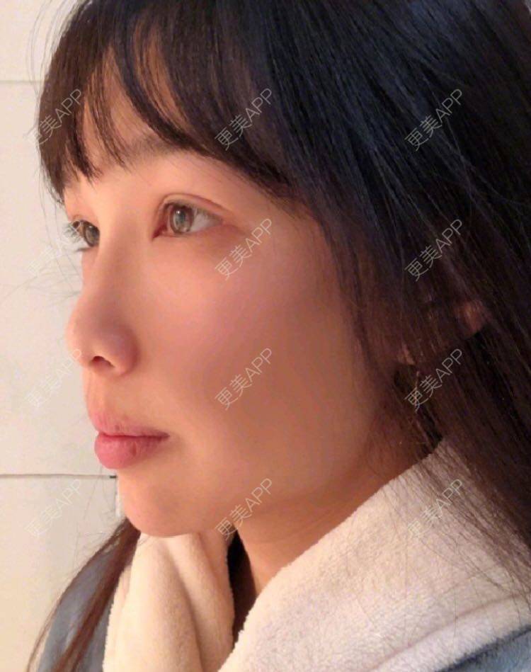 更美 - 愿out¨的颧骨内推经验 | 北京 | 颧骨内推