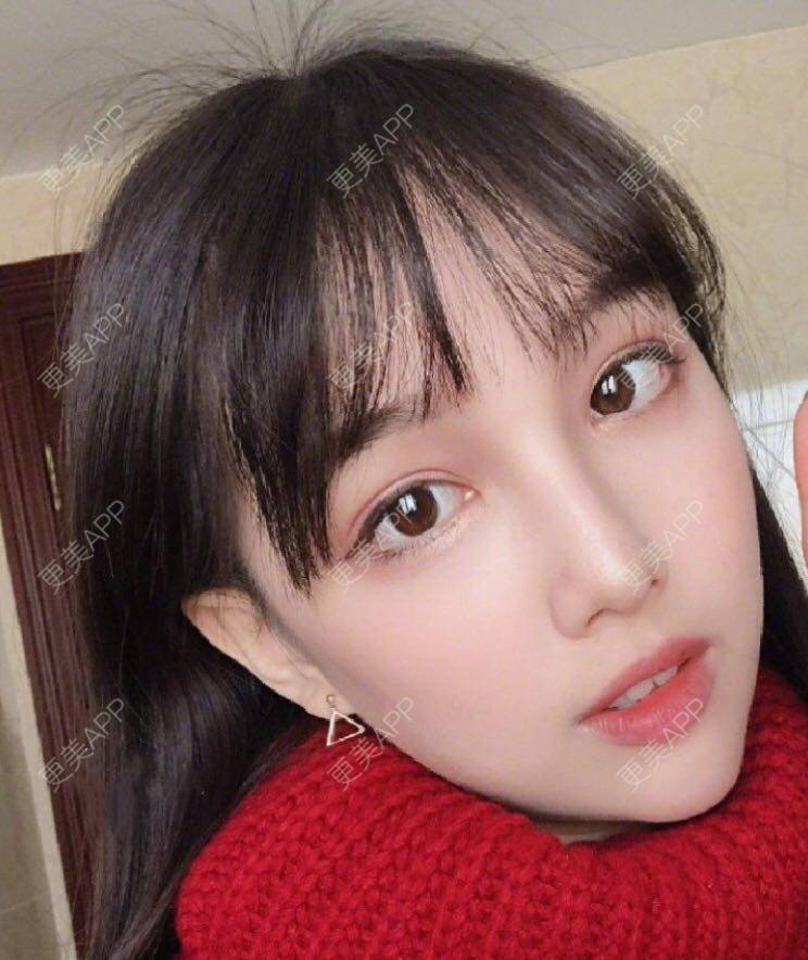 更美 - 愿out¨的颧骨内推经验 | 北京 | 颧骨内推 | 下颌角