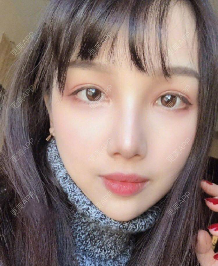 更美 - 愿out¨的颧骨内推经验 | 北京 | 颧骨内推 | 下颌角