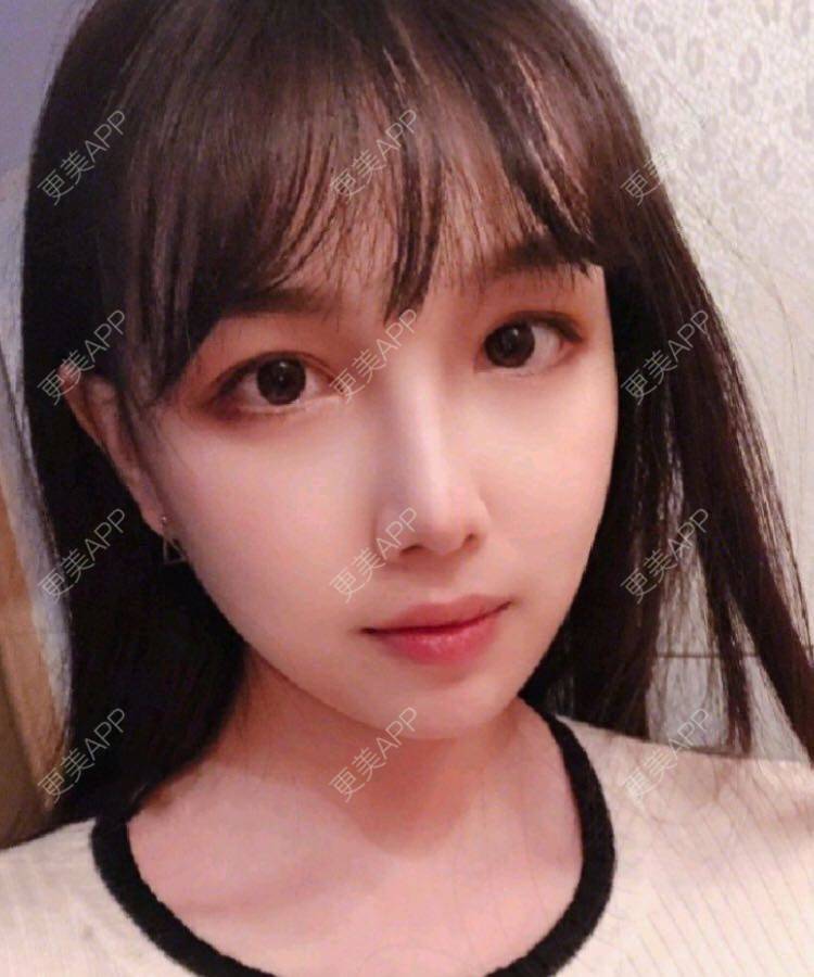 更美 - 愿out¨的颧骨内推经验 | 北京 | 颧骨内推 | 下颌角