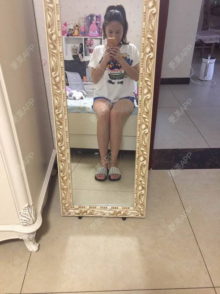 更美 - mylog的腰腹吸脂经验 | 腰腹吸脂 | 自体脂肪丰臀 | 天津 | 胶原蛋白丰臀 | 假体丰臀 | 射频溶脂塑臀