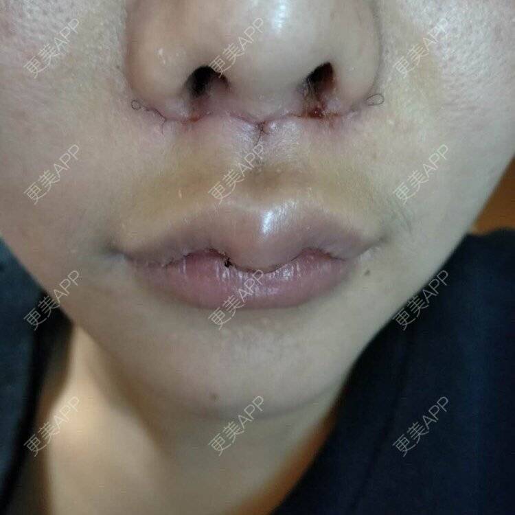 更美 - 僵尸涵的酒窝成形经验 | 人中缩短 | M唇成形 | 唇综合 | 微笑唇手术 | 胶原蛋白丰唇 | 厚唇改薄 | 玻尿酸唇部 | 成都