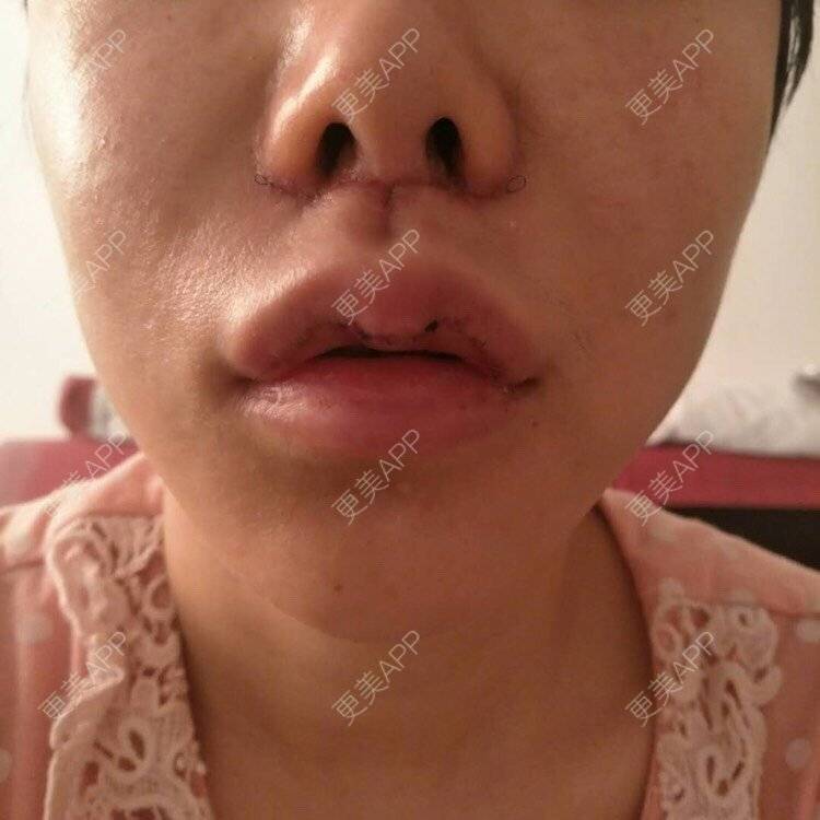 更美 - 僵尸涵的酒窝成形经验 | 人中缩短 | M唇成形 | 唇综合 | 微笑唇手术 | 胶原蛋白丰唇 | 厚唇改薄 | 玻尿酸唇部 | 成都