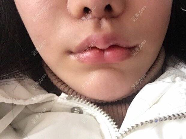 小孩170609的唇腭裂修复日记