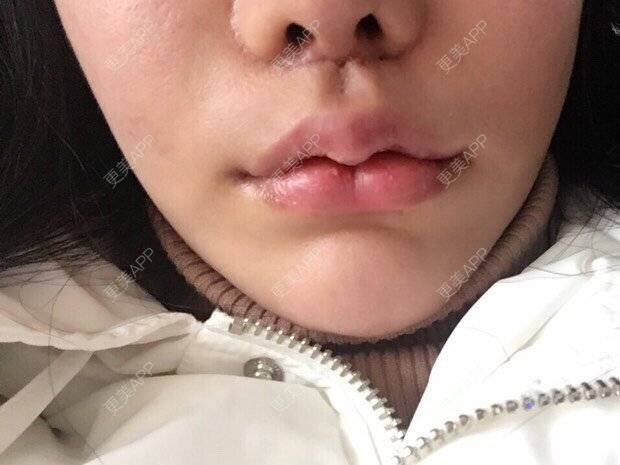 三瓣嘴重庆￥15000起【唇腭裂修复】唇腭裂修复兰州￥4800起【唇腭裂