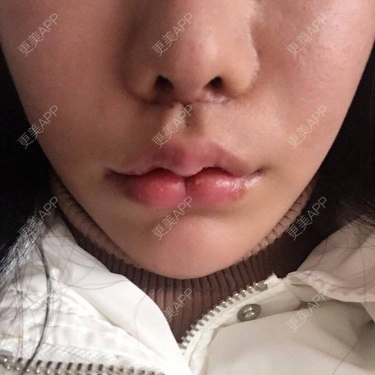 小孩170609的唇腭裂修复日记