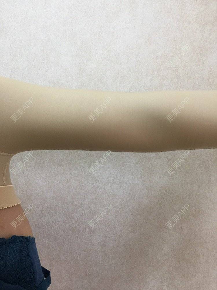 更美 - 小雨中行的背部吸脂经验 | 肩部吸脂 | 背部吸脂 | 手臂吸脂 | 射频溶脂瘦手臂 | 射频溶脂 | 天津