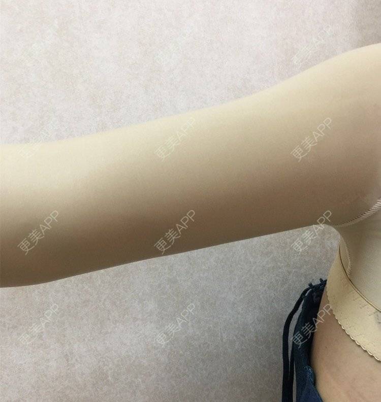 更美 - 小雨中行的背部吸脂经验 | 肩部吸脂 | 背部吸脂 | 手臂吸脂 | 射频溶脂瘦手臂 | 射频溶脂 | 天津
