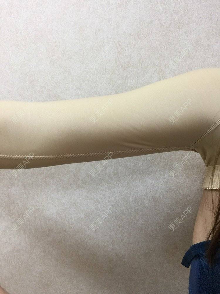 更美 - 小雨中行的背部吸脂经验 | 肩部吸脂 | 背部吸脂 | 手臂吸脂 | 射频溶脂瘦手臂 | 射频溶脂 | 天津
