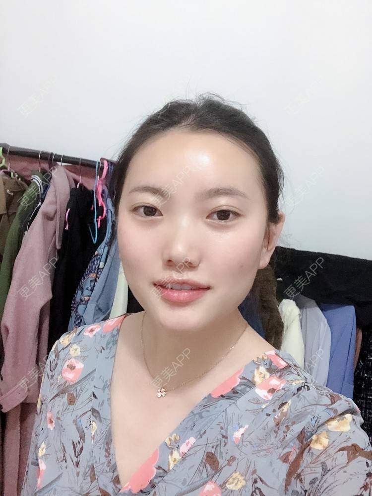 更美 - 冬日雪梅的妊娠纹经验 | 成都 | 像素激光 | 妊娠纹 | 激光淡化妊娠纹