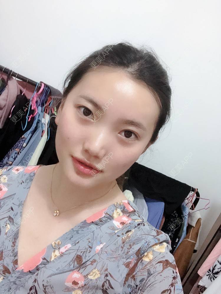 更美 - 冬日雪梅的妊娠纹经验 | 成都 | 像素激光 | 妊娠纹 | 激光淡化妊娠纹
