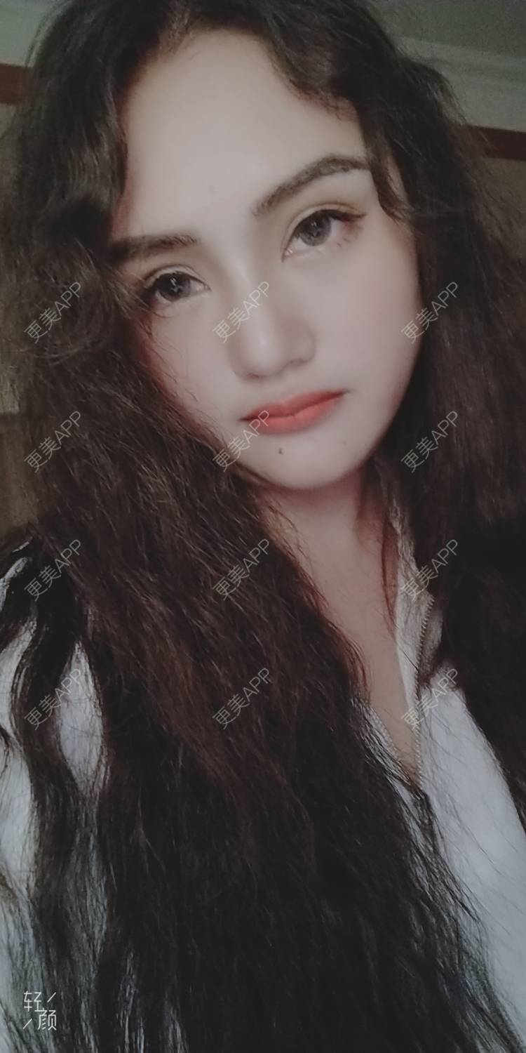 更美 - 红薯冰的祛眼袋经验 | 祛眼袋 | 开外眼角 | 外切去眼袋 | 自体脂肪填充泪沟 | 深圳