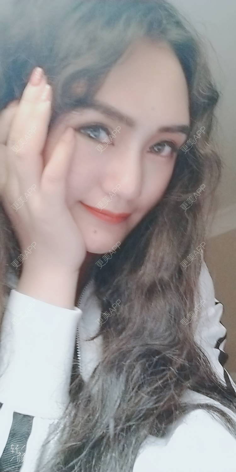 更美 - 红薯冰的祛眼袋经验 | 祛眼袋 | 开外眼角 | 外切去眼袋 | 自体脂肪填充泪沟 | 深圳