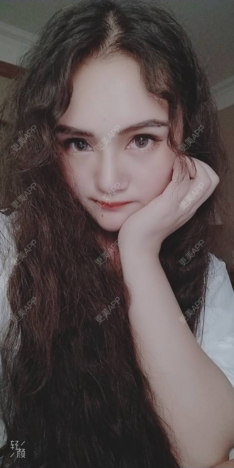 更美 - 红薯冰的祛眼袋经验 | 祛眼袋 | 开外眼角 | 外切去眼袋 | 自体脂肪填充泪沟 | 深圳