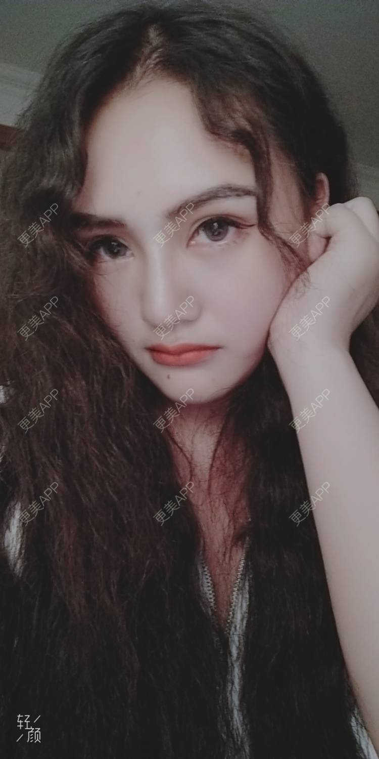 更美 - 红薯冰的祛眼袋经验 | 祛眼袋 | 开外眼角 | 外切去眼袋 | 自体脂肪填充泪沟 | 深圳