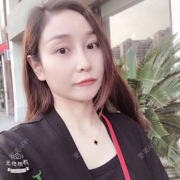 更美 - 蒙蒙噜噜噜的双眼皮修复经验 | 上海 | 双眼皮修复