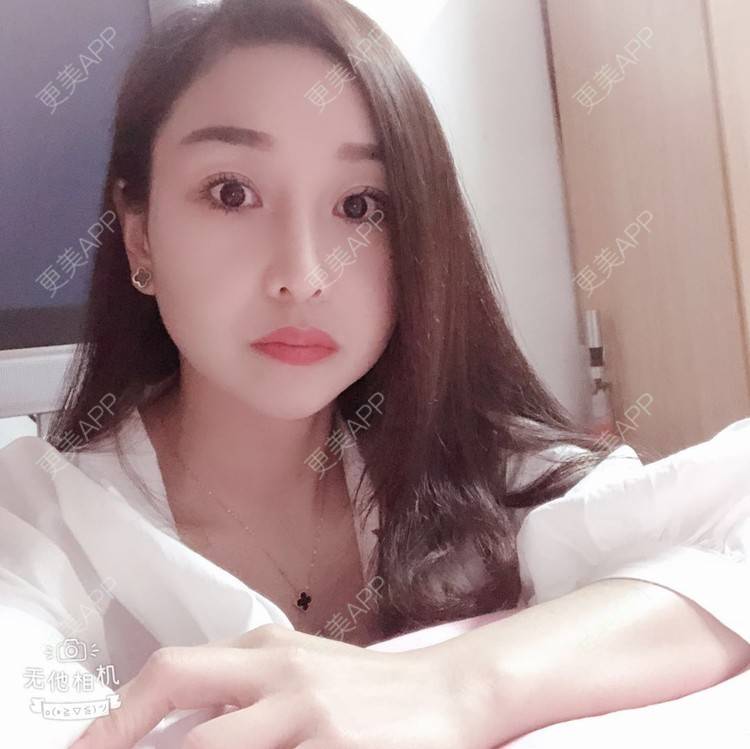 更美 - 蒙蒙噜噜噜的双眼皮修复经验 | 上海 | 双眼皮修复