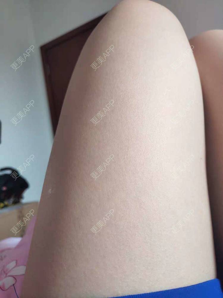 更美 - 堵你心头住你心上韭的激光脱毛经验 | 光子脱毛 | 激光脱毛 | 贵阳