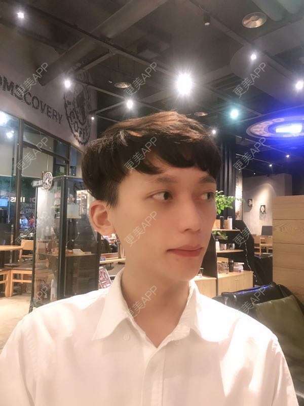 更美 - 幽默的超人的玻尿酸下巴经验 | 玻尿酸下巴 | 自体脂肪垫下巴 | 硅胶垫下巴 | 膨体垫下巴 | 重庆 | 胶原蛋白丰下巴
