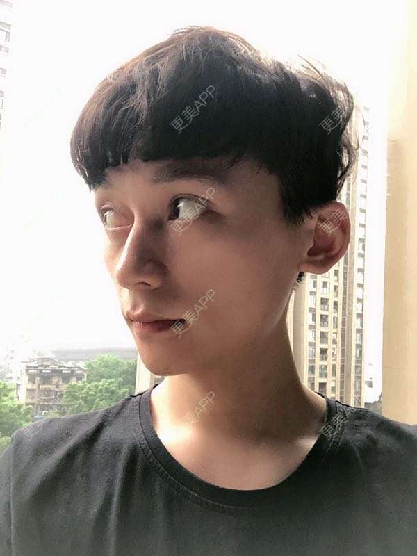 更美 - 幽默的超人的玻尿酸下巴经验 | 玻尿酸下巴 | 自体脂肪垫下巴 | 硅胶垫下巴 | 膨体垫下巴 | 重庆 | 胶原蛋白丰下巴