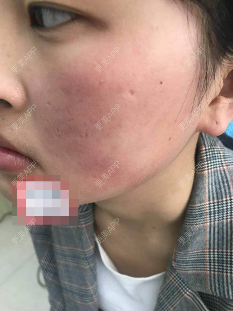 更美 - 更美用户zbTIjUxlUN的激光淡化红血丝经验 | 广州 | 激光淡化红血丝