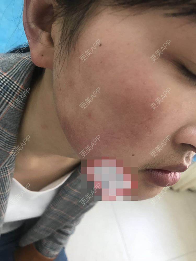 更美 - 更美用户zbTIjUxlUN的激光淡化红血丝经验 | 广州 | 激光淡化红血丝