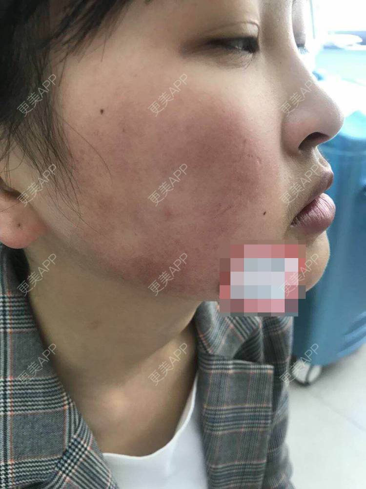 更美 - 更美用户zbTIjUxlUN的激光淡化红血丝经验 | 广州 | 激光淡化红血丝