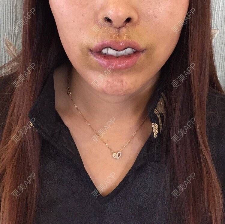 黑色儿南瓜的唇腭裂修复日记