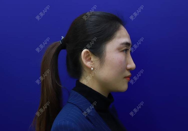 更美 - 更美用户lt1IEyirnq的玻尿酸苹果肌经验 | 长沙 | 玻尿酸苹果肌