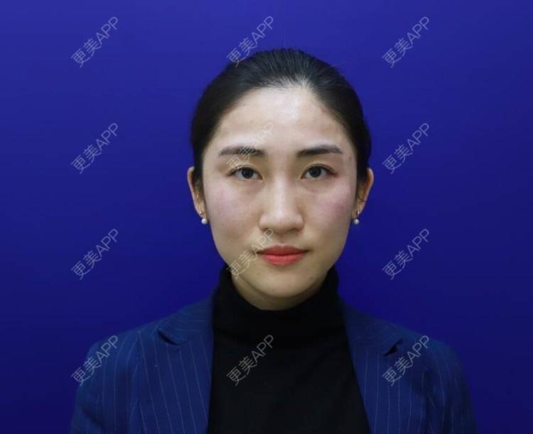 更美 - 更美用户lt1IEyirnq的玻尿酸苹果肌经验 | 长沙 | 玻尿酸苹果肌