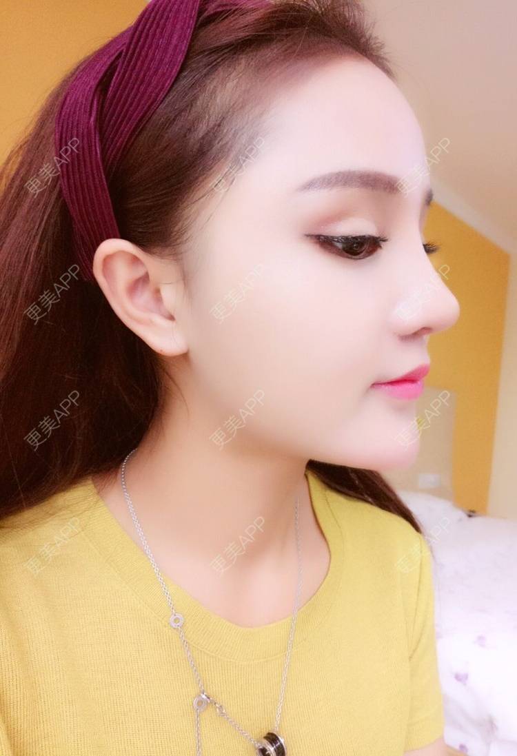 更美用户nxa9y15gjr的肋软骨隆鼻日记