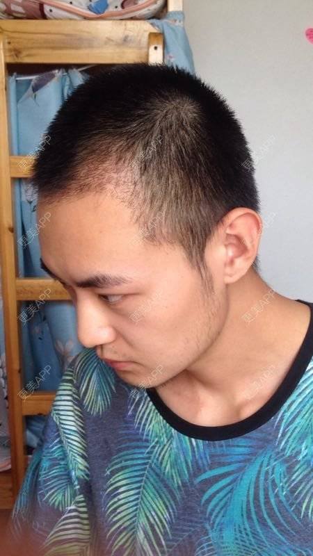 丶限量版帅仔的鬓角植发日记