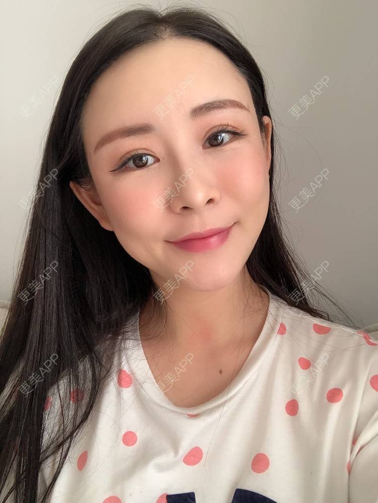 更美 - 兰质慧心的自体脂肪丰苹果肌经验 | 上海 | 视频日记 | 自体脂肪丰面颊 | 自体脂肪丰苹果肌 | 自体脂肪垫下巴