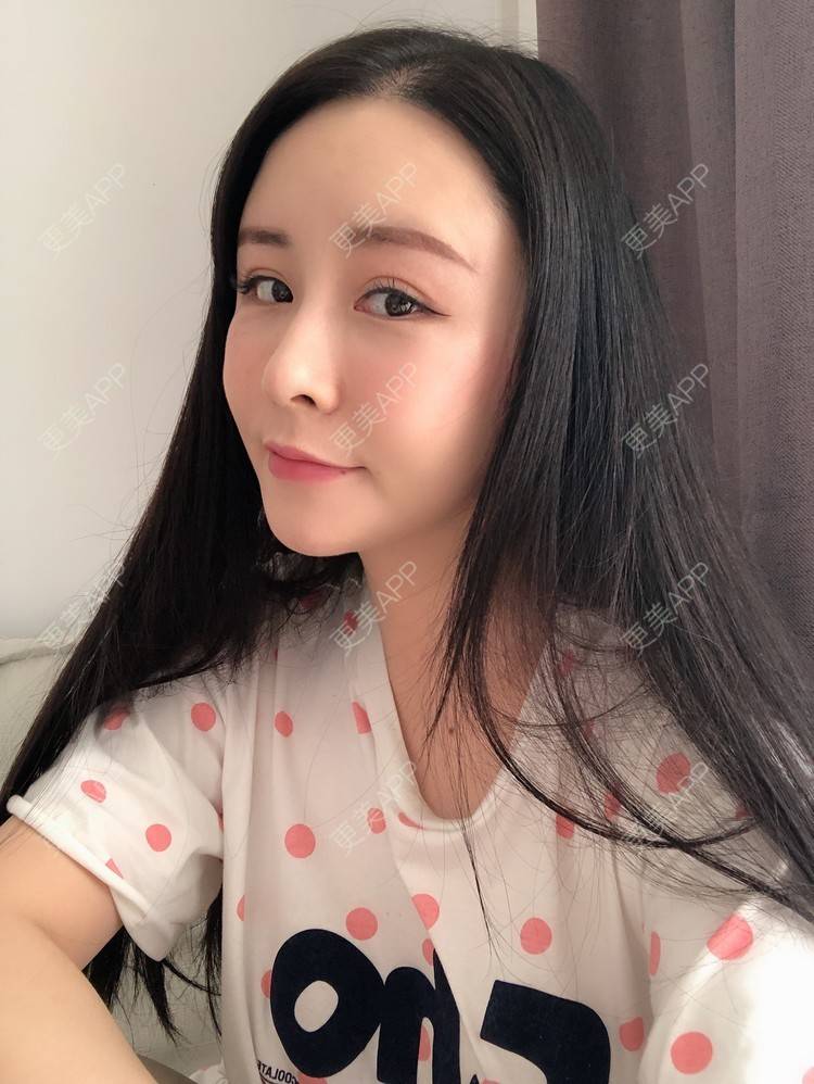 更美 - 兰质慧心的自体脂肪丰苹果肌经验 | 上海 | 视频日记 | 自体脂肪丰面颊 | 自体脂肪丰苹果肌 | 自体脂肪垫下巴