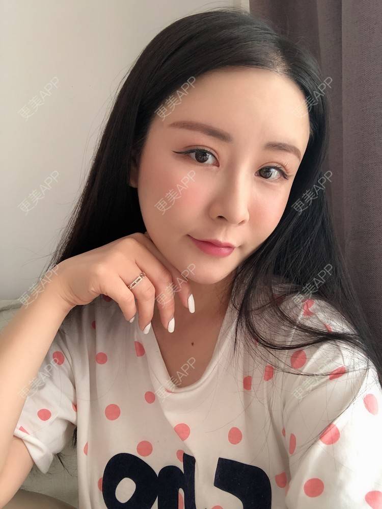 更美 - 兰质慧心的自体脂肪丰苹果肌经验 | 上海 | 视频日记 | 自体脂肪丰面颊 | 自体脂肪丰苹果肌 | 自体脂肪垫下巴