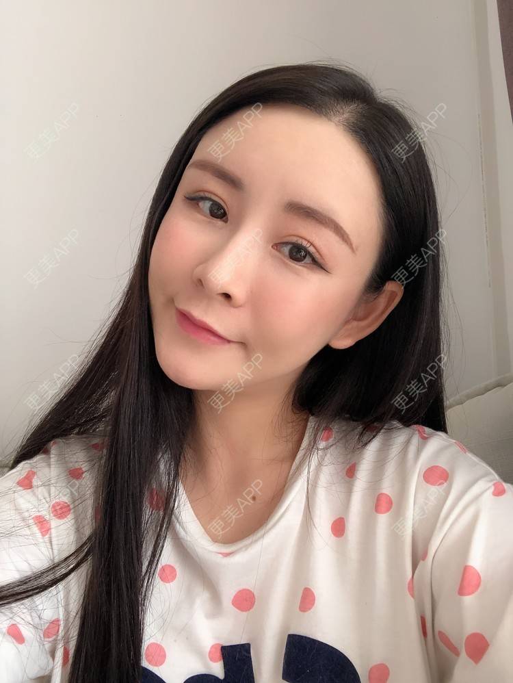 更美 - 兰质慧心的自体脂肪丰苹果肌经验 | 上海 | 视频日记 | 自体脂肪丰面颊 | 自体脂肪丰苹果肌 | 自体脂肪垫下巴