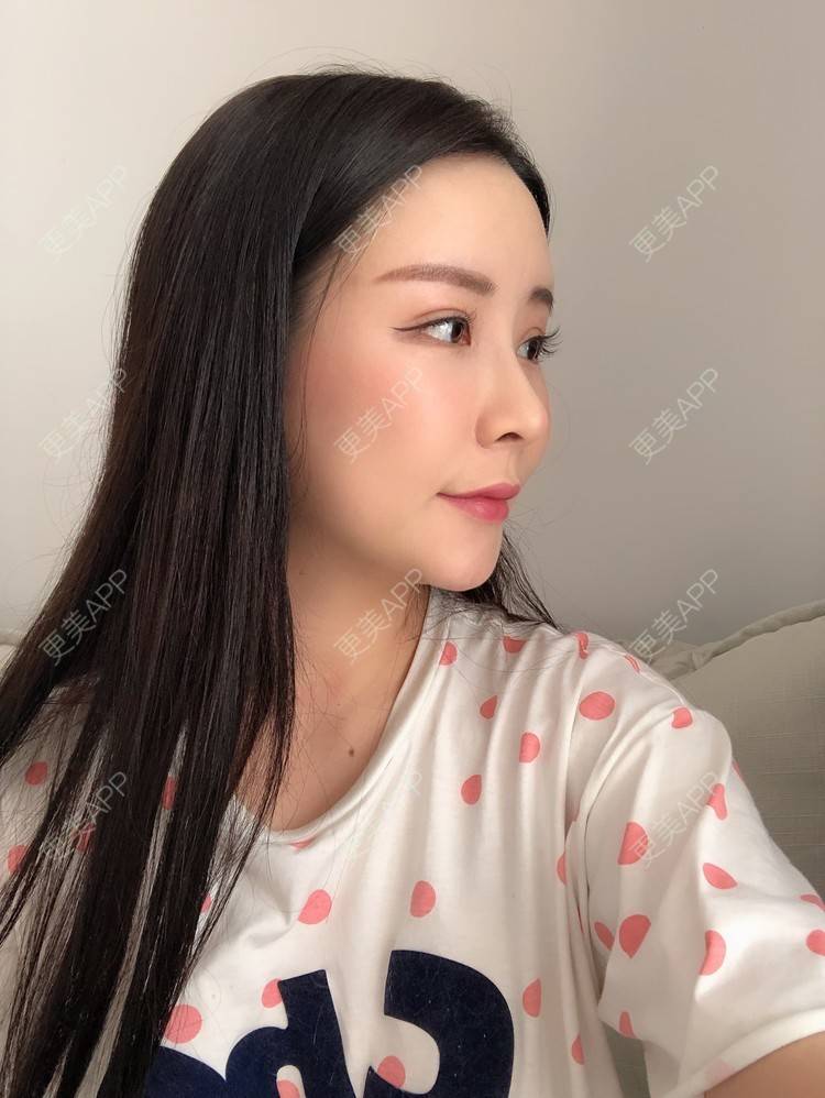 更美 - 兰质慧心的自体脂肪丰苹果肌经验 | 上海 | 视频日记 | 自体脂肪丰面颊 | 自体脂肪丰苹果肌 | 自体脂肪垫下巴
