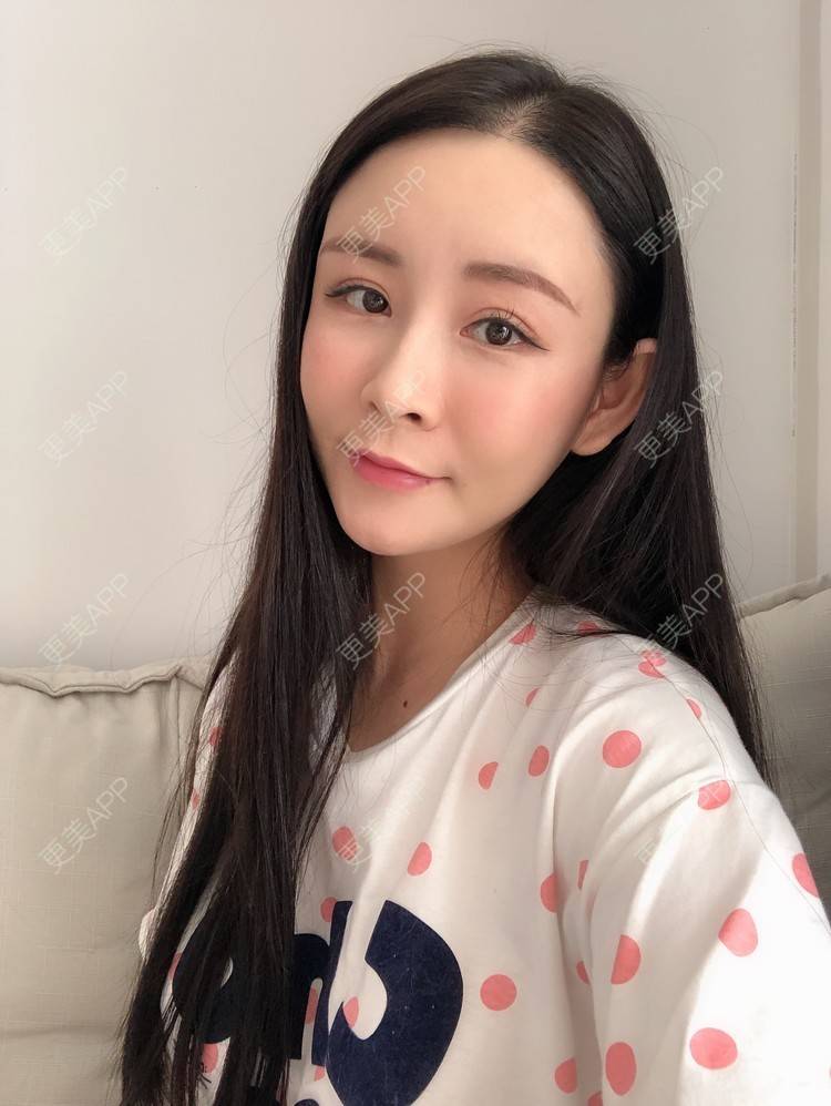 更美 - 兰质慧心的自体脂肪丰苹果肌经验 | 上海 | 视频日记 | 自体脂肪丰面颊 | 自体脂肪丰苹果肌 | 自体脂肪垫下巴