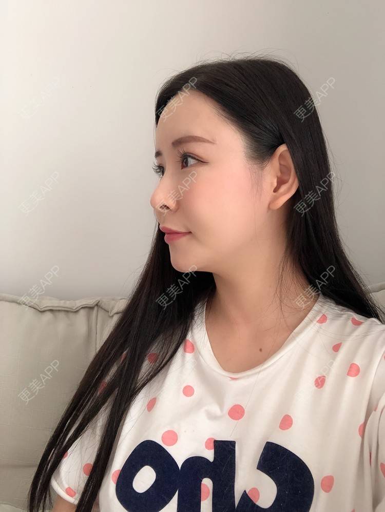 更美 - 兰质慧心的自体脂肪丰苹果肌经验 | 上海 | 视频日记 | 自体脂肪丰面颊 | 自体脂肪丰苹果肌 | 自体脂肪垫下巴