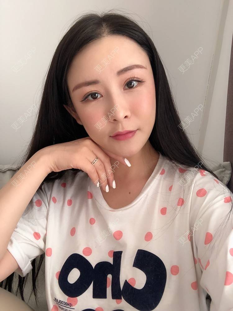 更美 - 兰质慧心的自体脂肪丰苹果肌经验 | 上海 | 视频日记 | 自体脂肪丰面颊 | 自体脂肪丰苹果肌 | 自体脂肪垫下巴