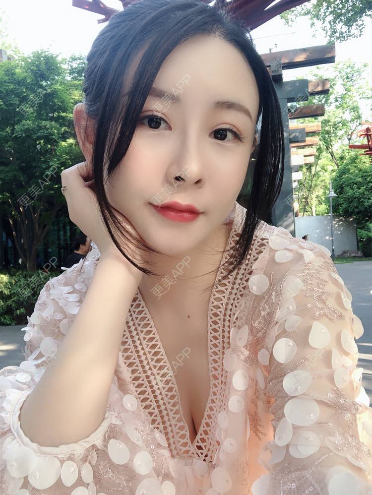 更美 - 兰质慧心的自体脂肪丰苹果肌经验 | 上海 | 视频日记 | 自体脂肪丰面颊 | 自体脂肪丰苹果肌 | 自体脂肪垫下巴